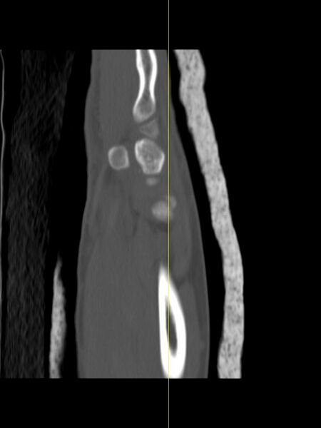 File:Chauffeur's (Hutchinson) fracture (Radiopaedia 58043-65079 Sagittal bone window 1).jpg
