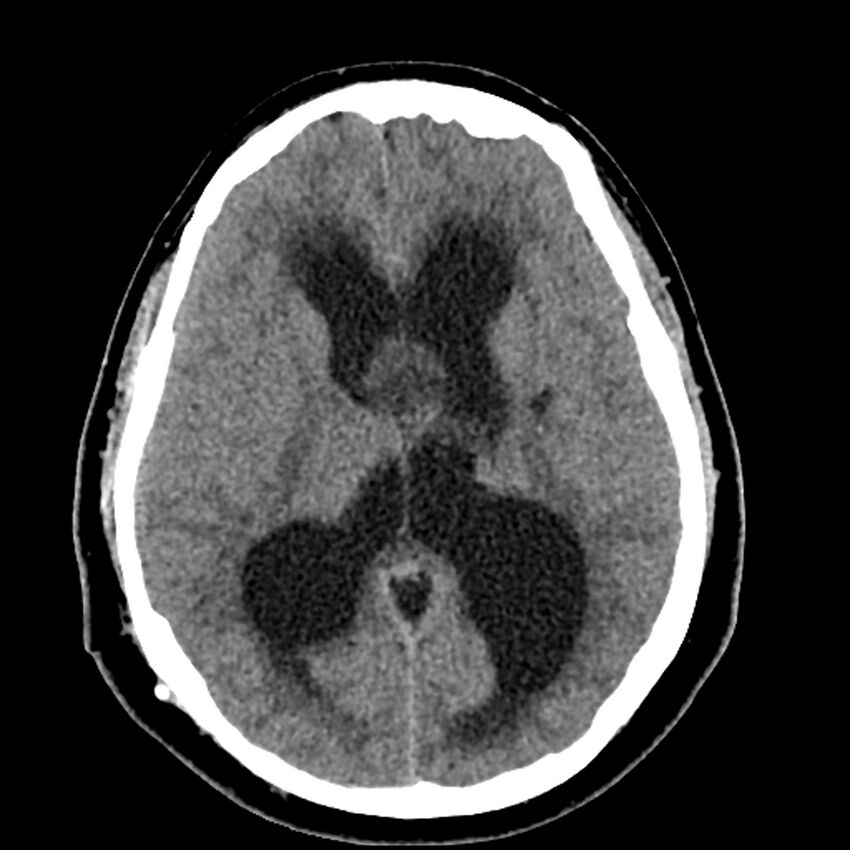 Chiasmatic-hypothalamic juvenile pilocytic astrocytoma (Radiopaedia 78533-91237 Axial non-contrast 31).jpg