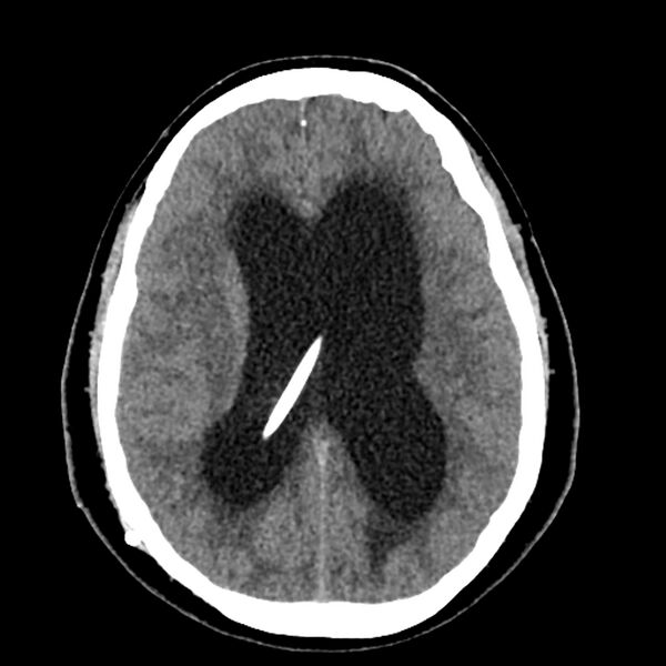 File:Chiasmatic-hypothalamic juvenile pilocytic astrocytoma (Radiopaedia 78533-91237 Axial non-contrast 35).jpg