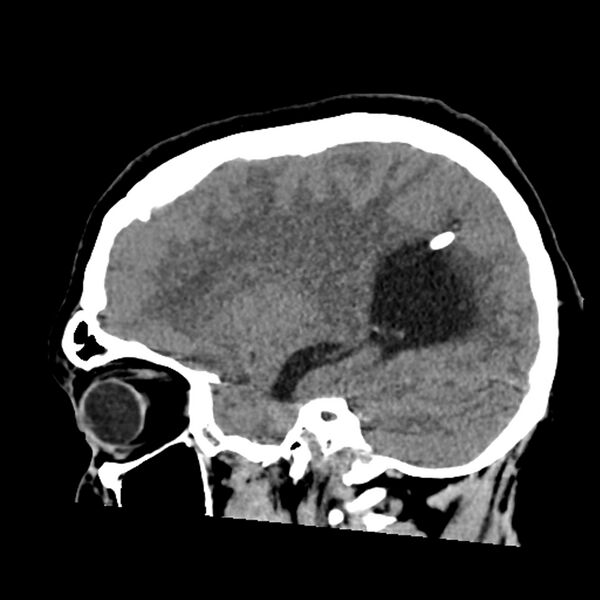 File:Chiasmatic-hypothalamic juvenile pilocytic astrocytoma (Radiopaedia 78533-91237 B 43).jpg