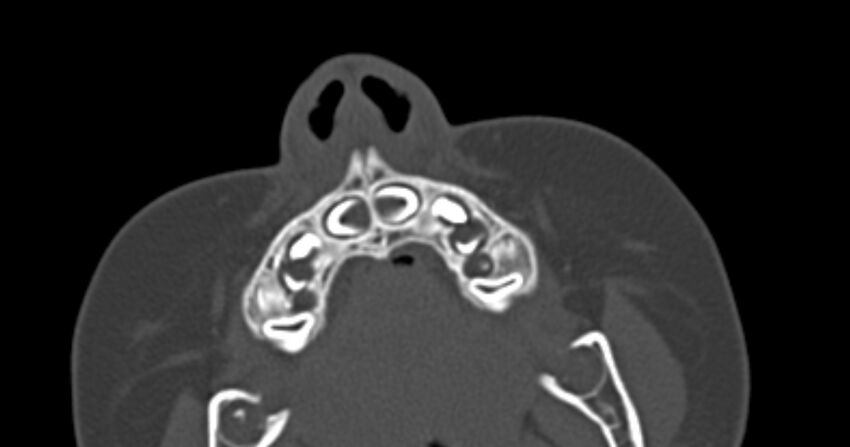 Choanal atresia (Radiopaedia 51295-56972 Axial bone window 1).jpg
