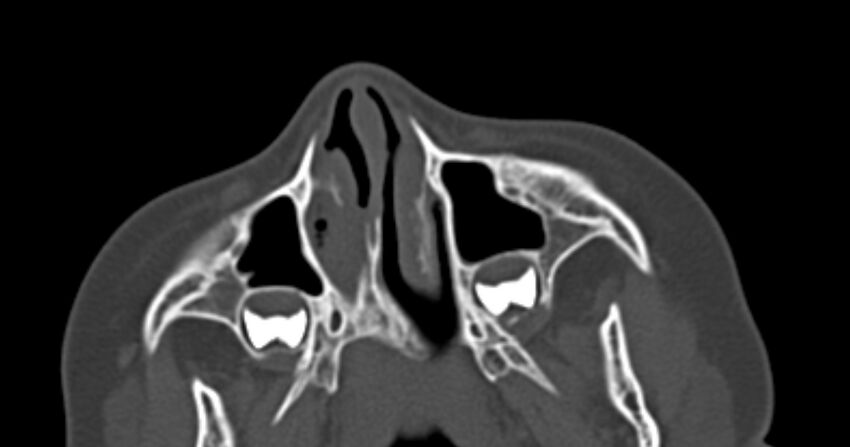 Choanal atresia (Radiopaedia 51295-56972 Axial bone window 15).jpg