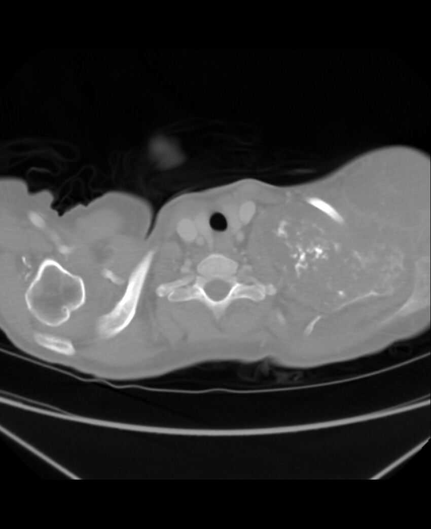 Chondrosarcoma (Radiopaedia 79427-92535 Axial lung window 1).jpg