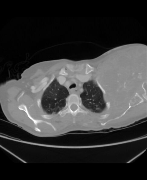 File:Chondrosarcoma (Radiopaedia 79427-92535 Axial lung window 9).jpg