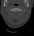 Chordoma (C4 vertebra) (Radiopaedia 47561-52188 Axial bone window 11).png