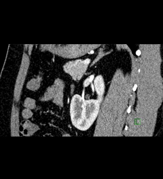 File:Chromophobe renal cell carcinoma (Radiopaedia 84286-99573 F 59).jpg