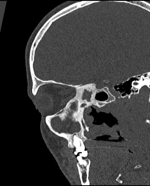 File:Chronic maxillary sinusitis caused by a foreign body (Radiopaedia 58521-65676 Sagittal bone window 40).jpg