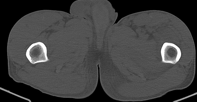 File:Chronic osteomyelitis (with sequestrum) (Radiopaedia 74813-85822 Axial non-contrast 62).jpg