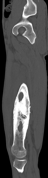File:Chronic osteomyelitis (with sequestrum) (Radiopaedia 74813-85822 C 77).jpg