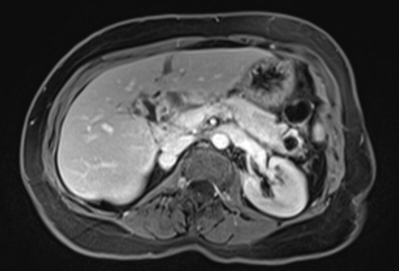 File:Chronic pancreatitis - pancreatic duct calculi (Radiopaedia 71818-82250 Axial T1 C+ fat sat 26).jpg