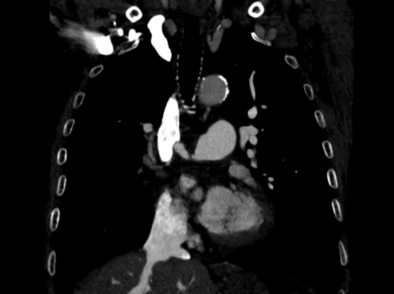 File:Chronic pulmonary embolism (Radiopaedia 91241-108843 A 47).jpg