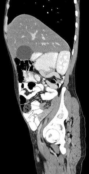 File:Chronic small bowel volvulus (Radiopaedia 75224-86322 C 106).jpg