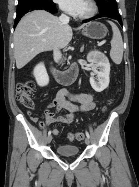 File:Clear cell renal cell carcinoma (Radiopaedia 61449-69393 F 13).jpg