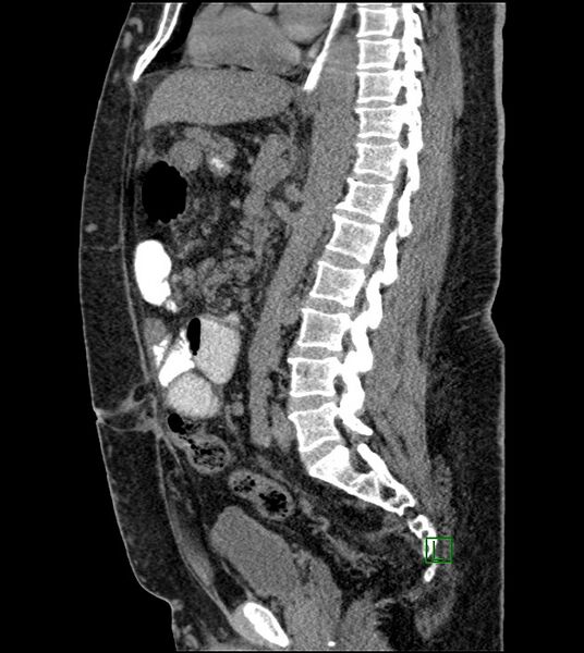 File:Closed-loop small bowel obstruction-internal hernia (Radiopaedia 78439-91096 C 73).jpg