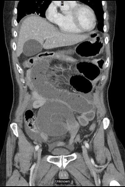 File:Closed loop bowel obstruction and ischemia (Radiopaedia 86959-103180 B 10).jpg
