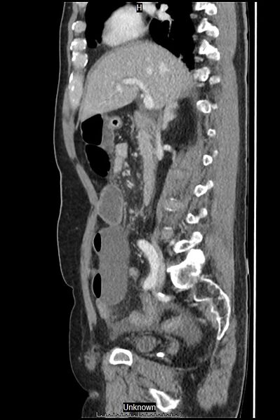 File:Closed loop bowel obstruction and ischemia (Radiopaedia 86959-103180 C 40).jpg