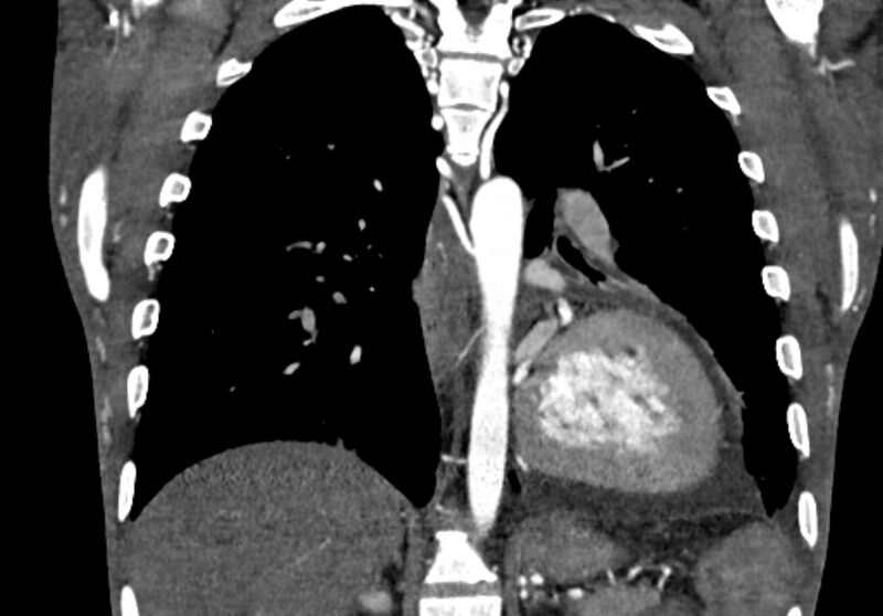 File:Coarctation of aorta with aortic valve stenosis (Radiopaedia 70463-80574 C 160).jpg