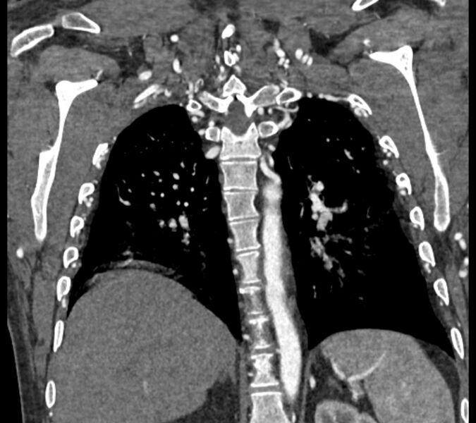 File:Coarctation of the aorta (Radiopaedia 53752-59822 B 58).jpg