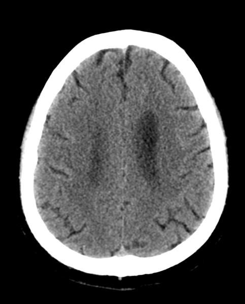 File:Colloid cyst of the third ventricle (Radiopaedia 86571-102661 Axial non-contrast 24).png