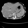 Colocolic fistula - Crohn disease (Radiopaedia 57063-63955 A 12).jpg