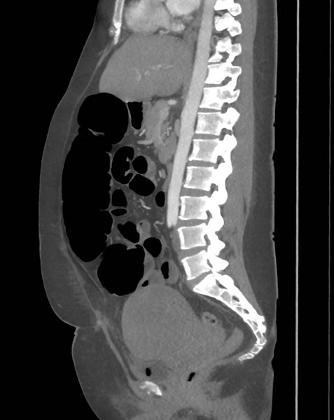 File:Colonic pseudo-obstruction (Radiopaedia 79752-92980 C 41).png