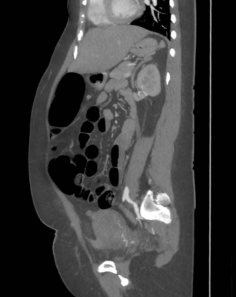 File:Colonic pseudo-obstruction (Radiopaedia 79752-92980 C 48).png