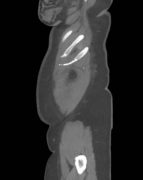 File:Colonic pseudo-obstruction (Radiopaedia 79752-92980 C 69).png