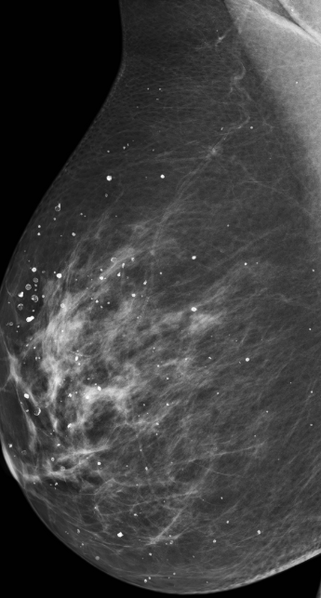 File:Cutaneous calcifications (mammography) (Radiopaedia 21485).png
