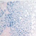 Hemochromatosis (hepatic histology) (Radiopaedia 9636).png