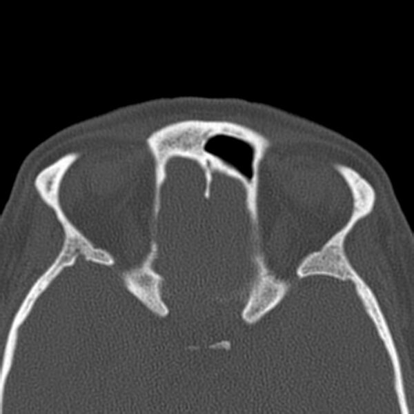 File:Nasolabial cyst (Radiopaedia 33987-35205 Axial bone window 37).jpg