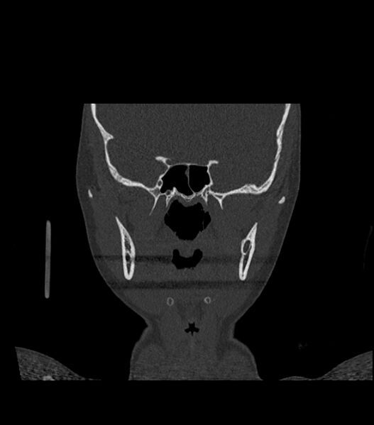 File:Nasoorbitoethmoid fracture (Radiopaedia 90044-107205 Coronal bone window 73).jpg