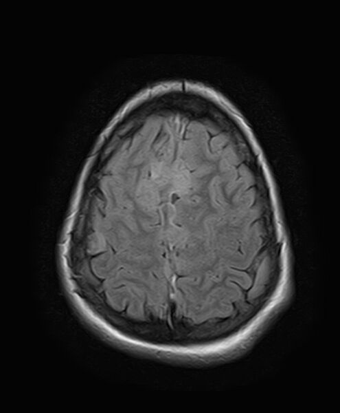 File:Neurofibromatosis type 2 (Radiopaedia 66211-75401 Axial FLAIR 24).jpg