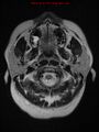 Neuroglial cyst (Radiopaedia 10713-11184 Axial T2 22).jpg