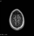 Neurosarcoidosis (Radiopaedia 10930-11351 Axial T1 19).jpg