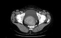 Non-puerperal uterine inversion (Radiopaedia 78343-91094 A 65).jpg