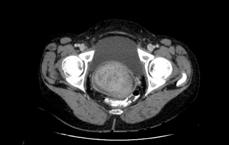 File:Non-puerperal uterine inversion (Radiopaedia 78343-91094 A 65).jpg