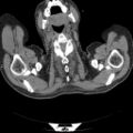 Non Hodgkin lymphoma in a patient with ankylosing spondylitis (Radiopaedia 84323-99624 Axial non-contrast 1).jpg