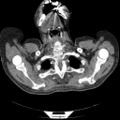 Non Hodgkin lymphoma in a patient with ankylosing spondylitis (Radiopaedia 84323-99624 Axial non-contrast 4).jpg