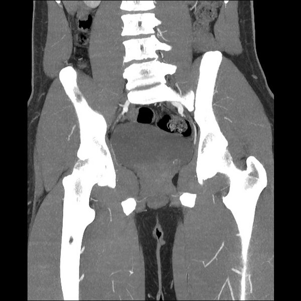 File:Normal CT angiogram of pelvis (Radiopaedia 45390-49430 B 28).jpg
