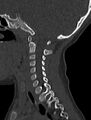 Normal CT cervical spine - pediatric (Radiopaedia 52549-58462 Sagittal bone window 136).jpg