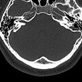 Normal CT of the cervical spine (Radiopaedia 53322-59305 Axial bone window 5).jpg