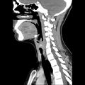 Normal CT of the neck (Radiopaedia 14575-14500 Sagittal C+ 30).jpg