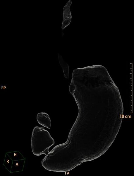 File:Normal CT virtual gastroscopy (Radiopaedia 29960-30501 3D Transparency view 1).jpg