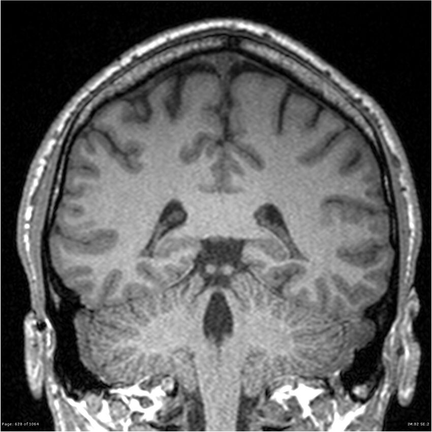 Normal brain MRI (non-focal epilepsy protocol) (Radiopaedia 38571-40700 Coronal T1 40).jpg