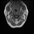 Normal cervical and thoracic spine MRI (Radiopaedia 35630-37156 Axial T1 27).png