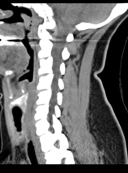 File:Normal cervical spine MRI (including Dixon) (Radiopaedia 42762-45926 C 25).png