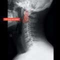 Normal cervical spine radiographs (Radiopaedia 32505-96697 A 6).jpeg