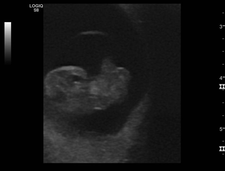 Normal early pregnancy - 8w0d (Radiopaedia 44715-48492 Longitudinal 35).jpg