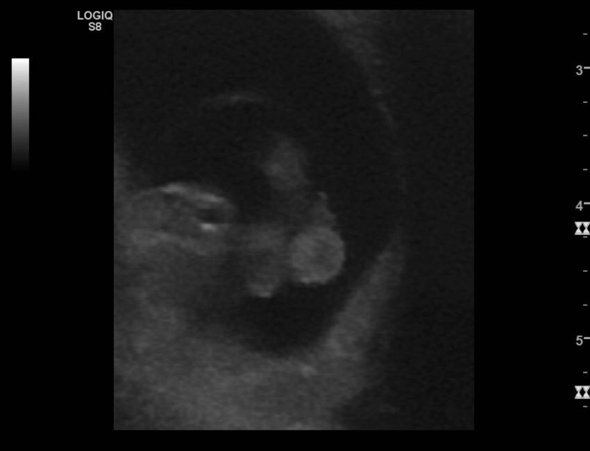 Normal early pregnancy - 8w0d (Radiopaedia 44715-48492 Longitudinal 44).jpg