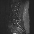 Normal lumbar spine MRI (Radiopaedia 47857-52609 Sagittal STIR 7).jpg